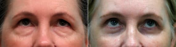 Before and after Blepharoplasty by Dr. Shervin Naderi, Patient 19149