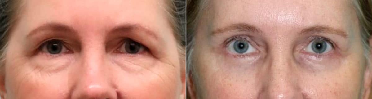 Before and after Blepharoplasty by Dr. Shervin Naderi, Patient 19149