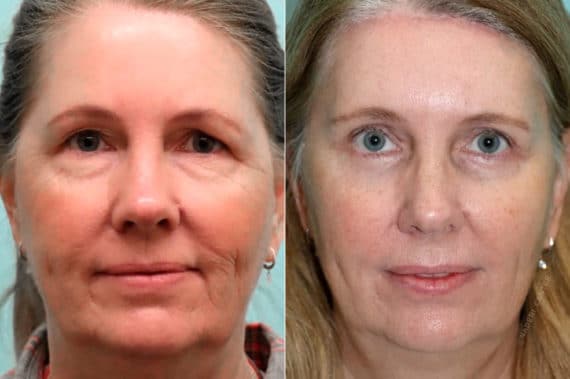 Before and after Blepharoplasty by Dr. Shervin Naderi, Patient 19149