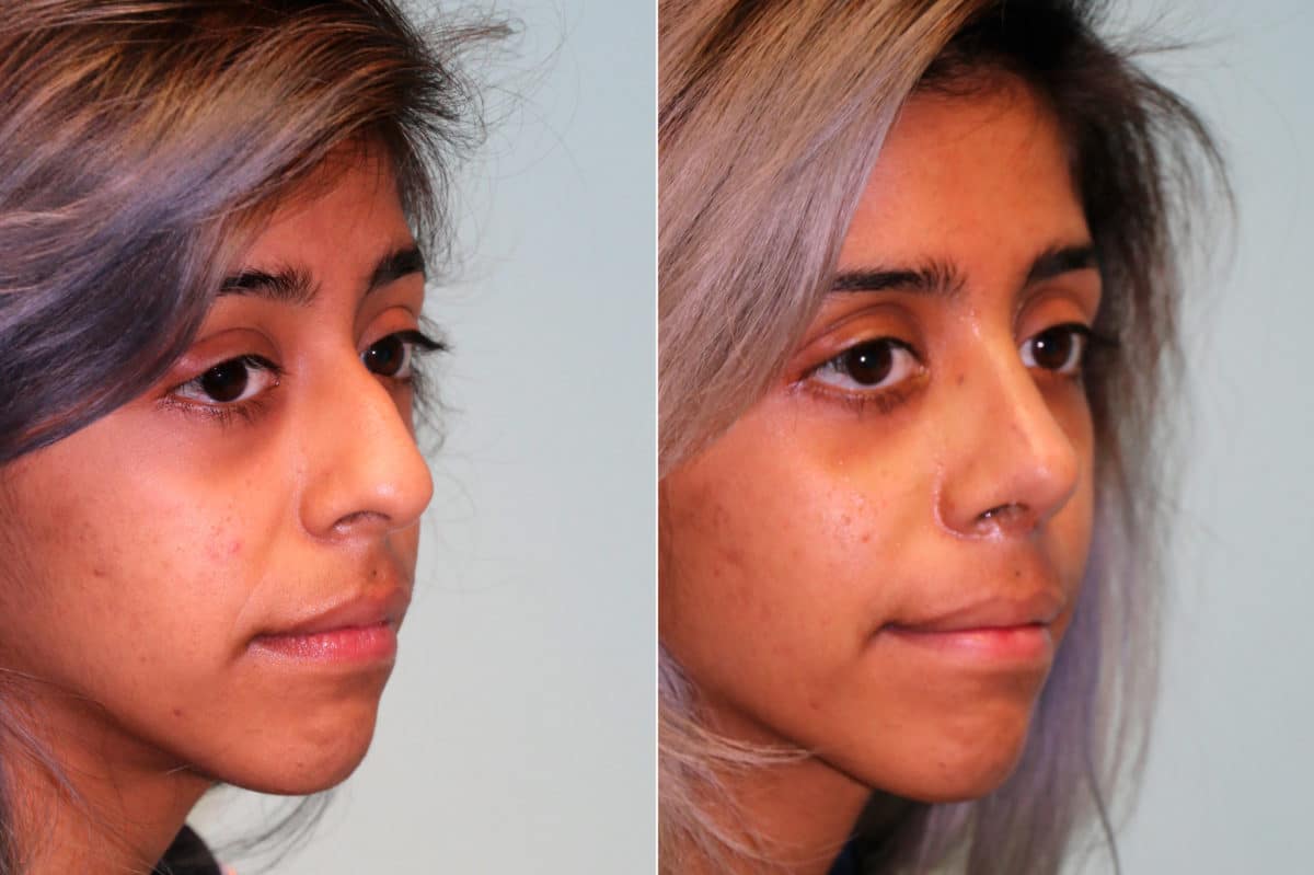 Before and after Rhinoplasty by Dr. Shervin Naderi, Patient 19199