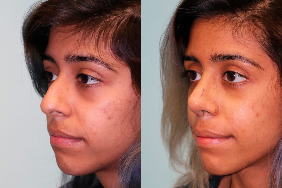 Before and after Rhinoplasty by Dr. Shervin Naderi, Patient 19199