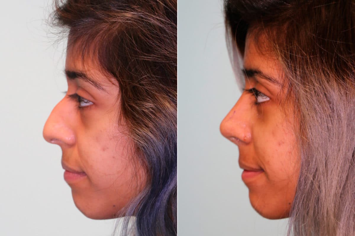 Before and after Rhinoplasty by Dr. Shervin Naderi, Patient 19199