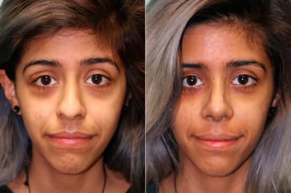 Before and after Rhinoplasty by Dr. Shervin Naderi, Patient 19199