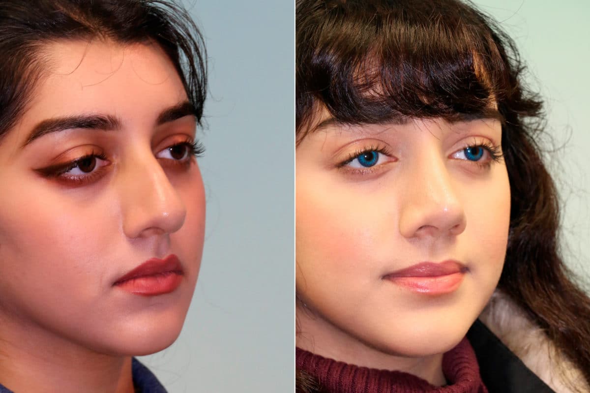 Before and after Rhinoplasty by Dr. Shervin Naderi, Patient 19236