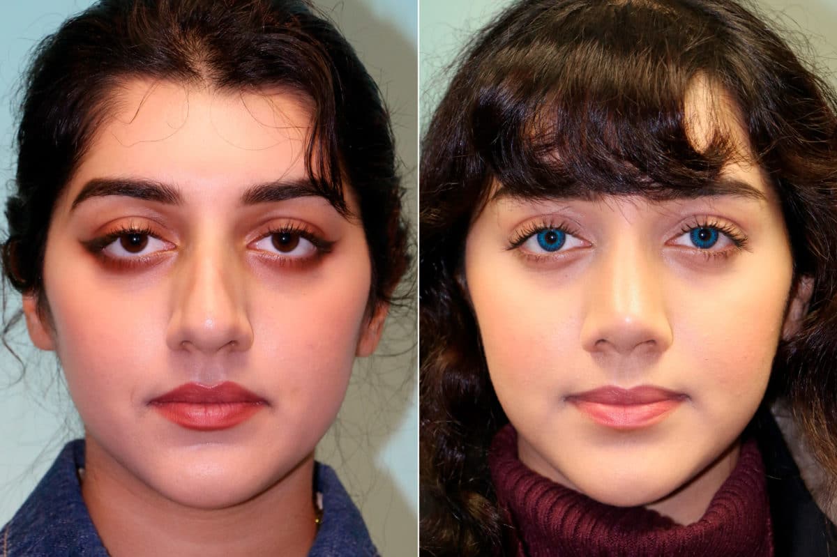 Before and after Rhinoplasty by Dr. Shervin Naderi, Patient 19236