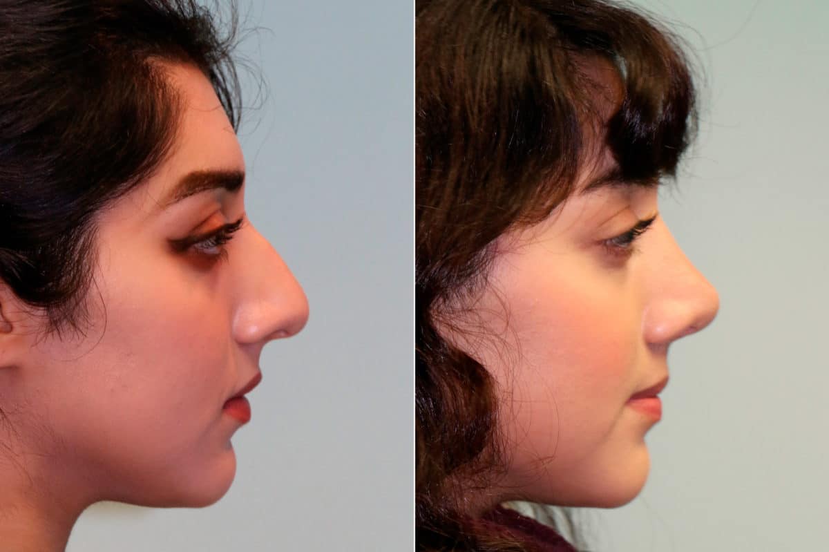 Before and after Rhinoplasty by Dr. Shervin Naderi, Patient 19236