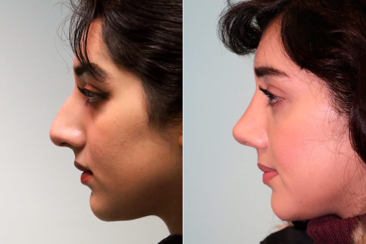 Before and after Rhinoplasty by Dr. Shervin Naderi, Patient 19236