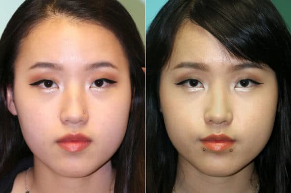 Before and after Rhinoplasty by Dr. Shervin Naderi, Patient 19339