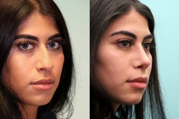 Before and after Rhinoplasty by Dr. Shervin Naderi, Patient 19358