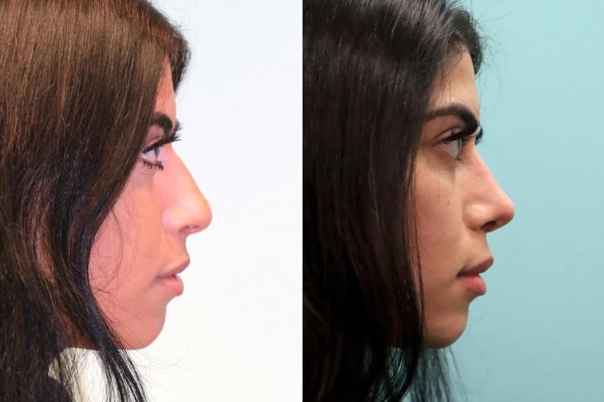 Before and after Rhinoplasty by Dr. Shervin Naderi, Patient 19358