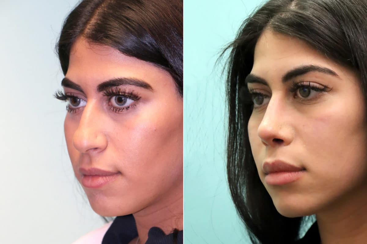 Before and after Rhinoplasty by Dr. Shervin Naderi, Patient 19358