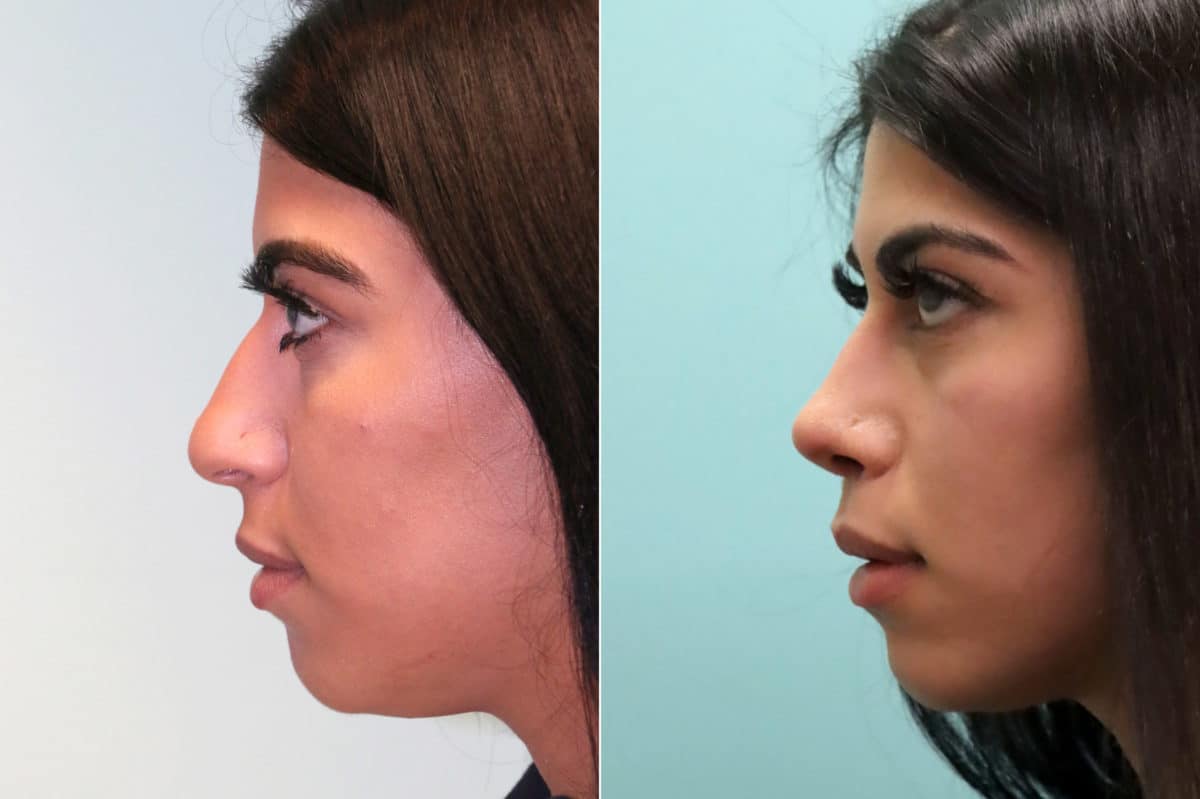 Before and after Rhinoplasty by Dr. Shervin Naderi, Patient 19358