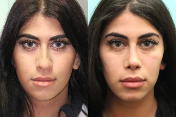 Before and after Rhinoplasty by Dr. Shervin Naderi, Patient 19358