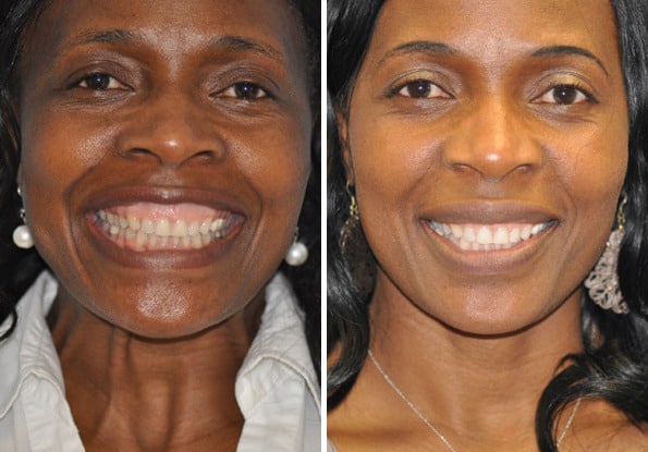 Before and after Botox Injections by Dr. Shervin Naderi, Patient 8960