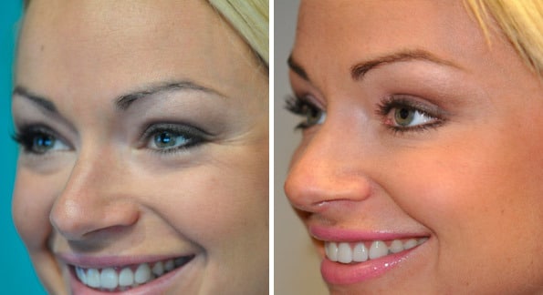 Before and after Botox Injections by Dr. Shervin Naderi, Patient 8961