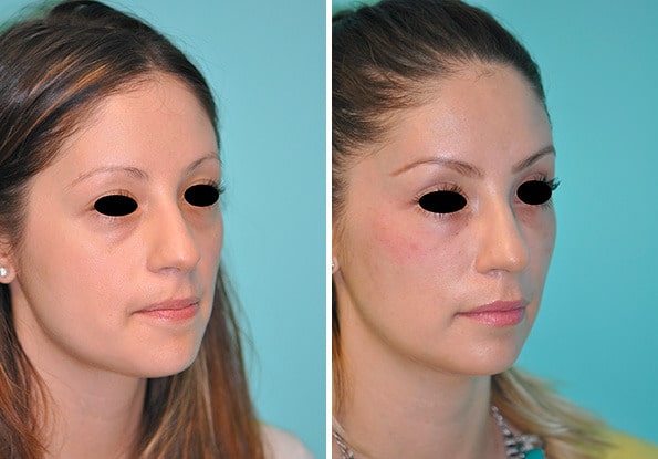 Before and after Botox Injections by Dr. Shervin Naderi, Patient 8964