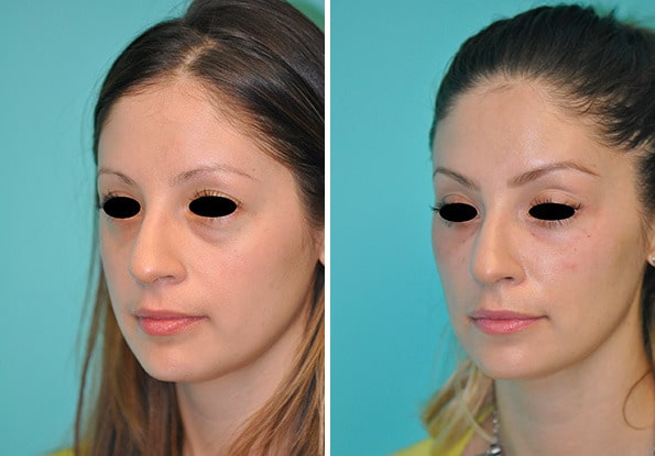 Before and after Botox Injections by Dr. Shervin Naderi, Patient 8964