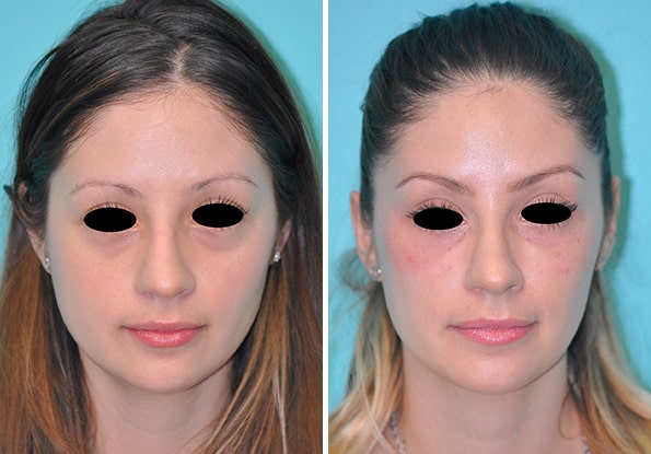 Before and after Botox Injections by Dr. Shervin Naderi, Patient 8964