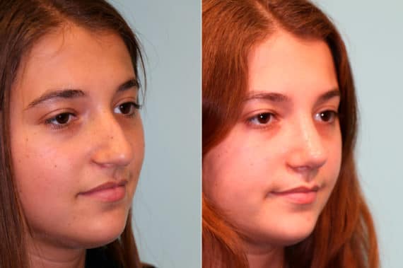 Before and after Rhinoplasty by Dr. Shervin Naderi, Patient 19253