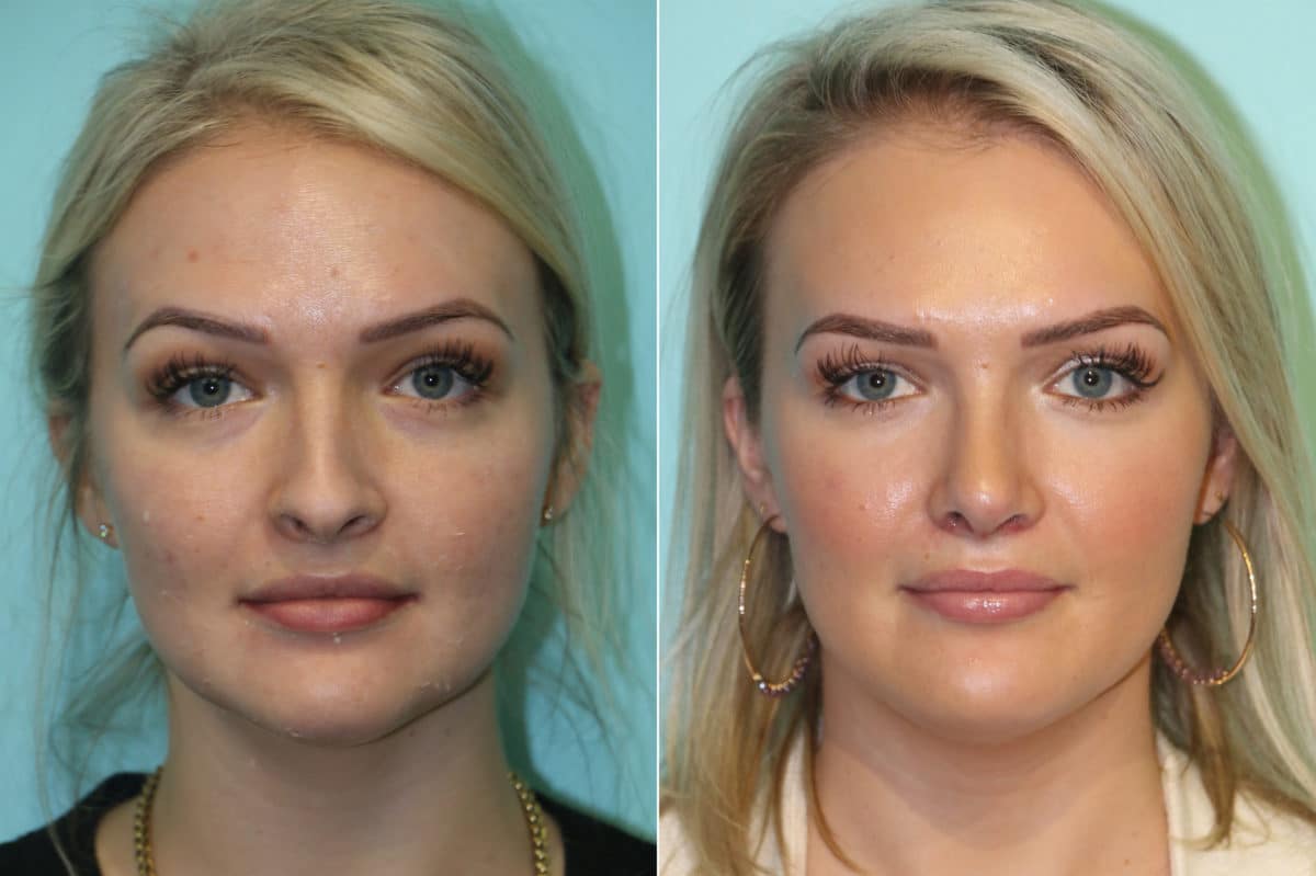 Before and after Rhinoplasty by Dr. Shervin Naderi, Patient 19387