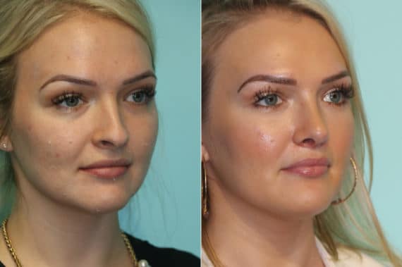 Before and after Rhinoplasty by Dr. Shervin Naderi, Patient 19387