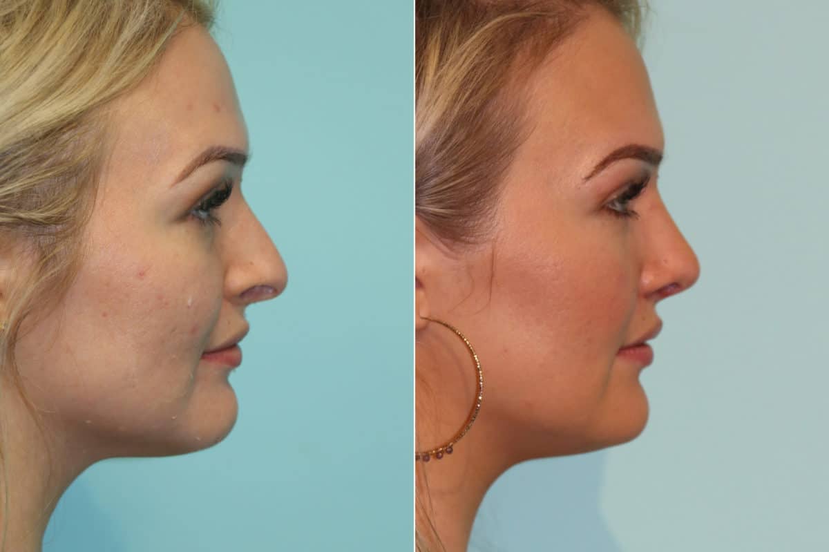 Before and after Rhinoplasty by Dr. Shervin Naderi, Patient 19387