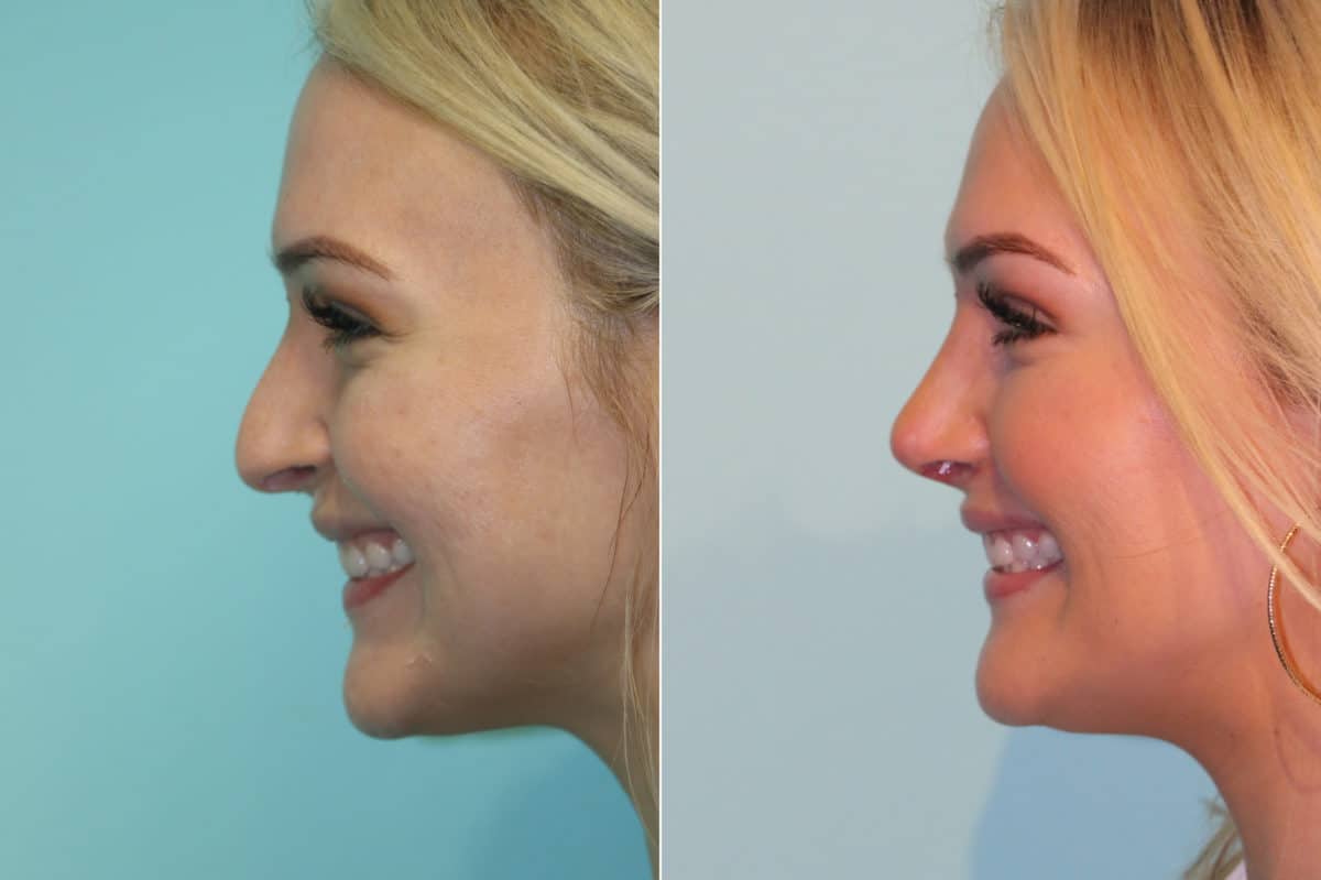 Before and after Rhinoplasty by Dr. Shervin Naderi, Patient 19387