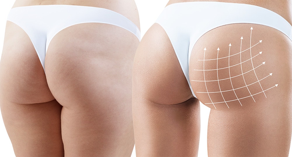 The buttocks will be marked prior to the procedure to indicate regions for desired enhancement.