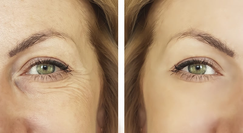 Skin on the lateral sides of the eyes become thinner and fine lines appear.