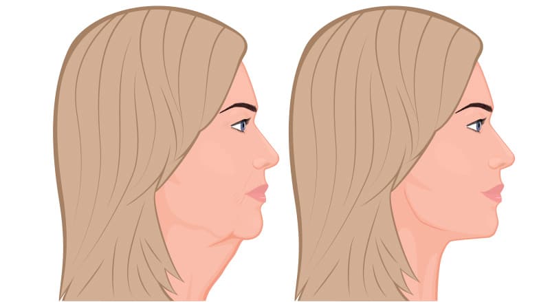 Jowls are formed from collagen loss, elastin loss, and facial muscles weakening.