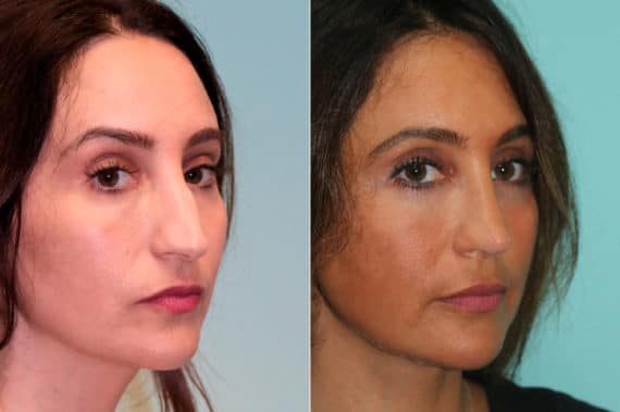 Before and after Rhinoplasty by Dr. Shervin Naderi, Patient 19506