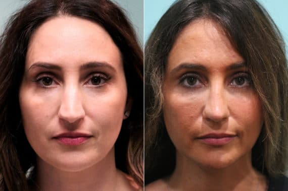 Before and after Rhinoplasty by Dr. Shervin Naderi, Patient 19506