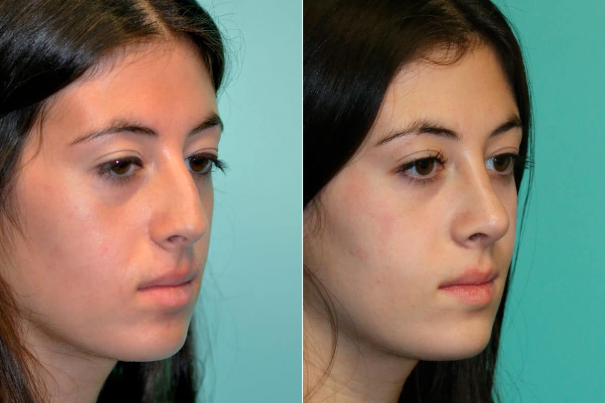 Before and after Rhinoplasty by Dr. Shervin Naderi, Patient 19522