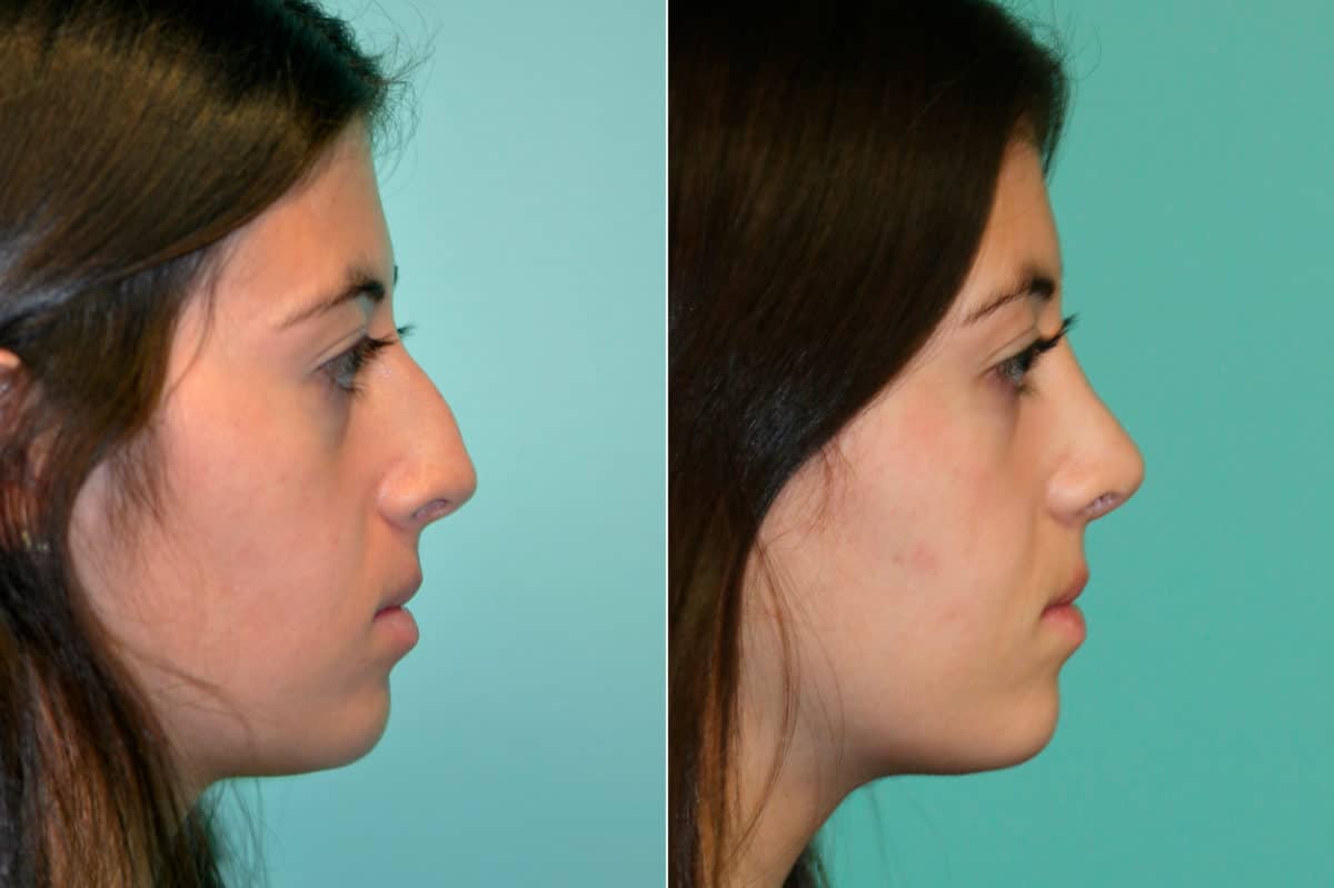 Before and after Rhinoplasty by Dr. Shervin Naderi, Patient 19522