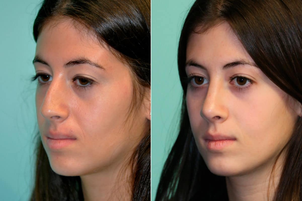 Before and after Rhinoplasty by Dr. Shervin Naderi, Patient 19522