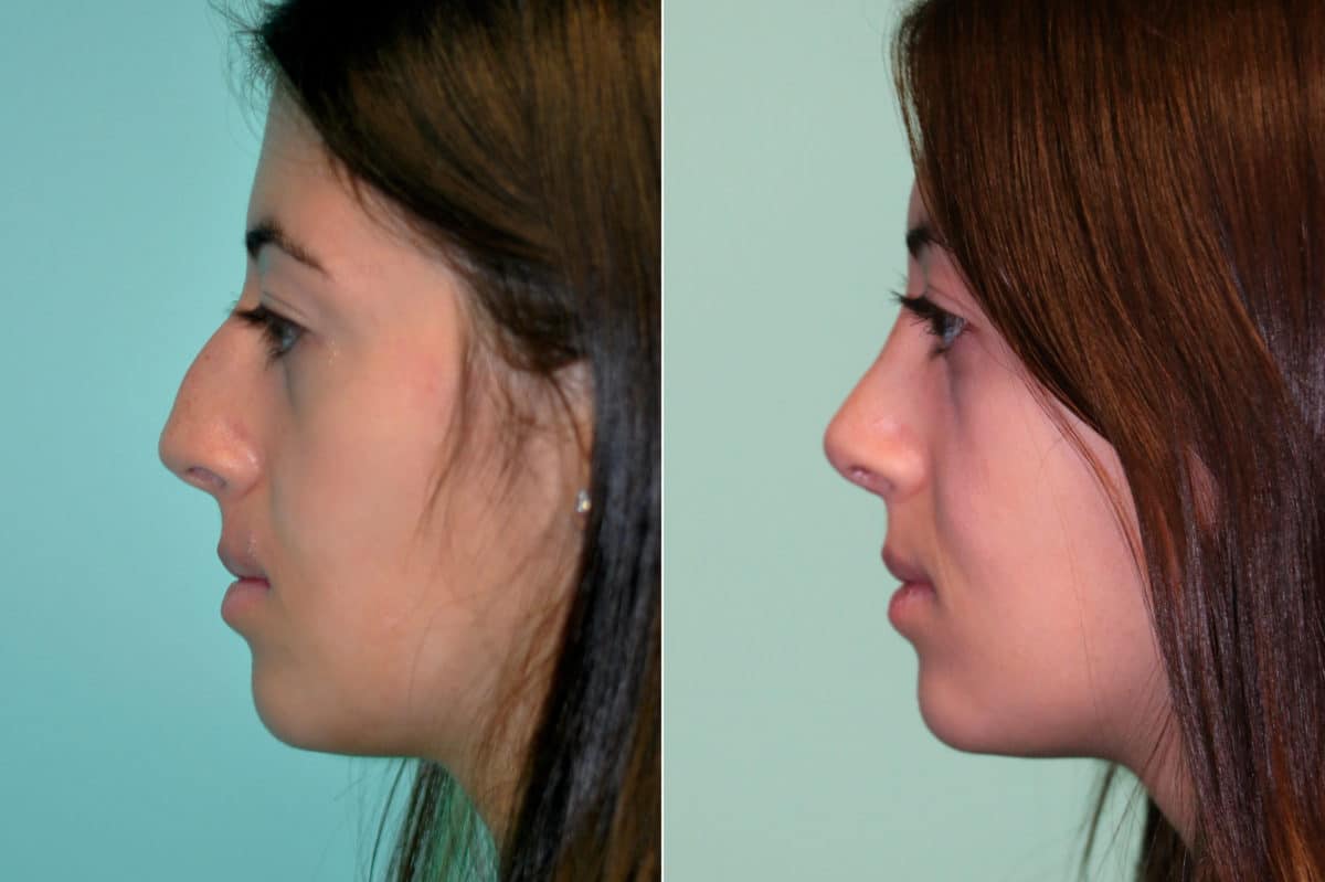 Before and after Rhinoplasty by Dr. Shervin Naderi, Patient 19522