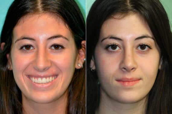 Before and after Rhinoplasty by Dr. Shervin Naderi, Patient 19522