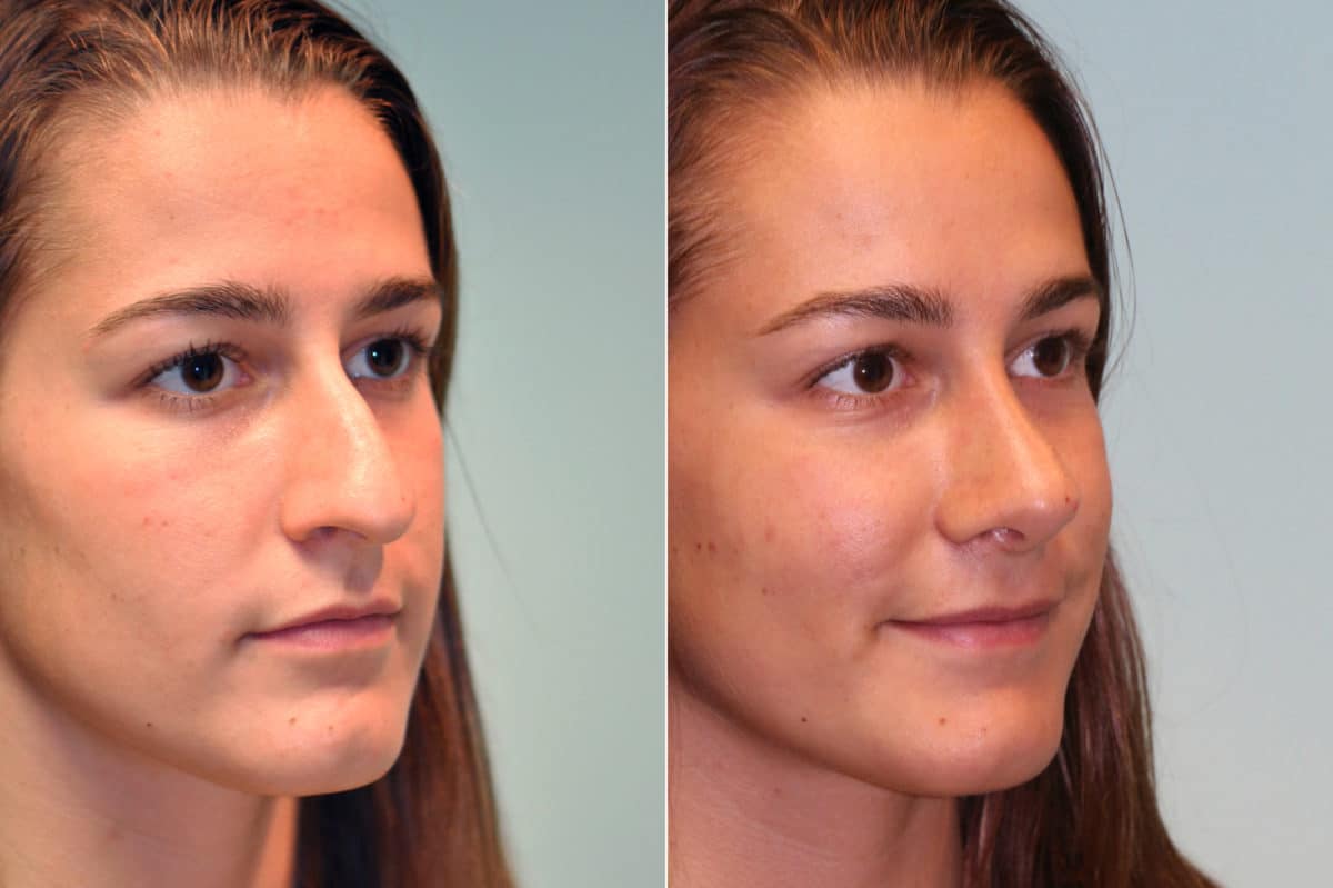 Before and after Rhinoplasty by Dr. Shervin Naderi, Patient 19538