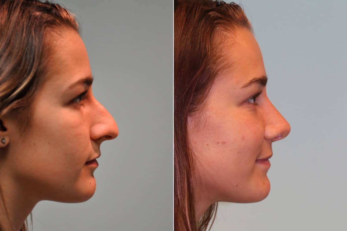 Before and after Rhinoplasty by Dr. Shervin Naderi, Patient 19538