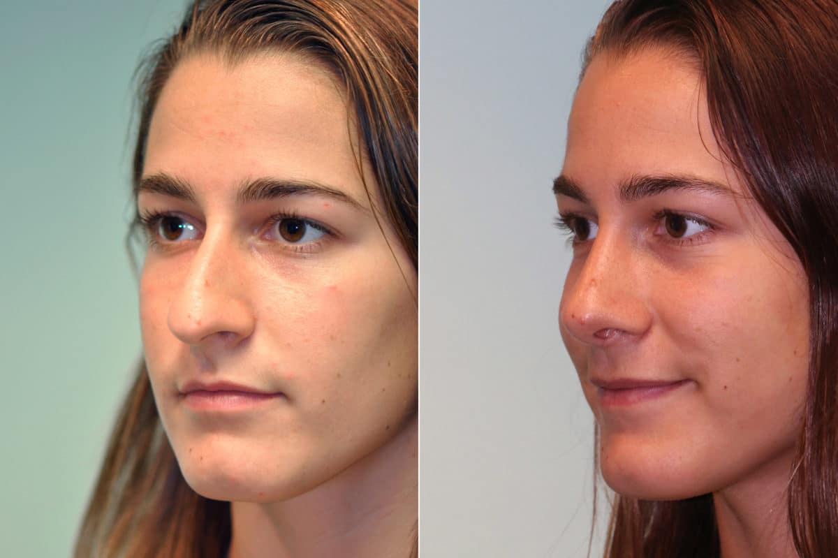 Patient 19538, Rhinoplasty Before and After Photos Before and after Rhinoplasty by Dr. Shervin Naderi, Patient 19538