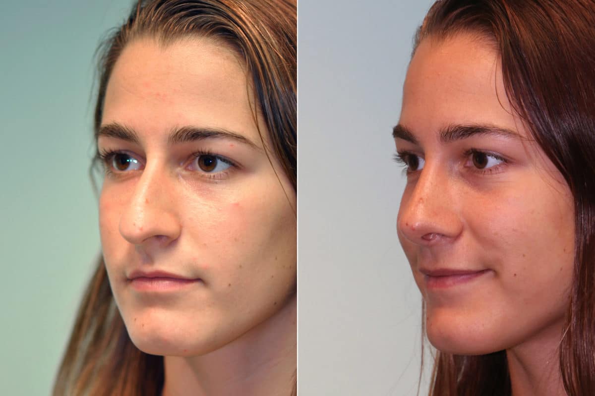 Before and after Rhinoplasty by Dr. Shervin Naderi, Patient 19538