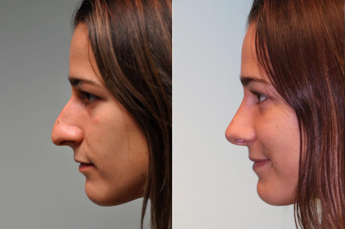 Before and after Rhinoplasty by Dr. Shervin Naderi, Patient 19538