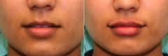 Before and after Lip Injections by Dr. Shervin Naderi, Patient 19554