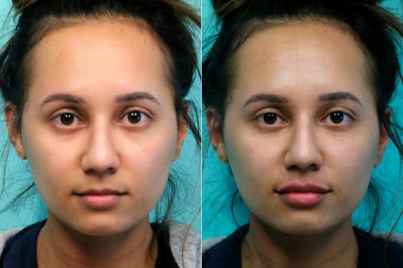 Before and after Lip Injections by Dr. Shervin Naderi, Patient 19554