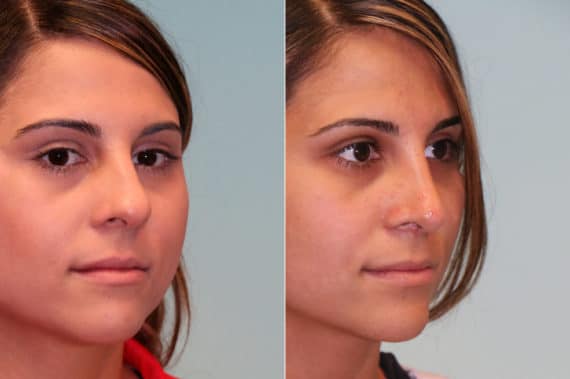 Before and after Rhinoplasty by Dr. Shervin Naderi, Patient 19565