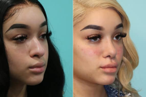 Before and after Cheeks / Midface Injections by Dr. Shervin Naderi, Patient 19620