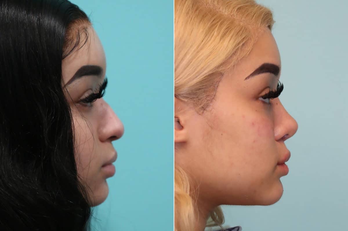 Before and after Cheeks / Midface Injections by Dr. Shervin Naderi, Patient 19620