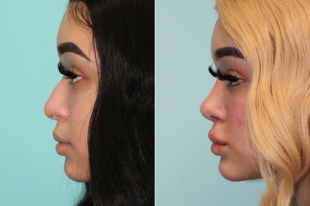 Before and after Cheeks / Midface Injections by Dr. Shervin Naderi, Patient 19620