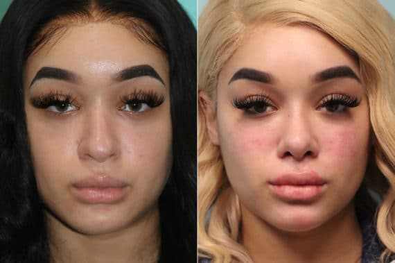 Before and after Cheeks / Midface Injections by Dr. Shervin Naderi, Patient 19620