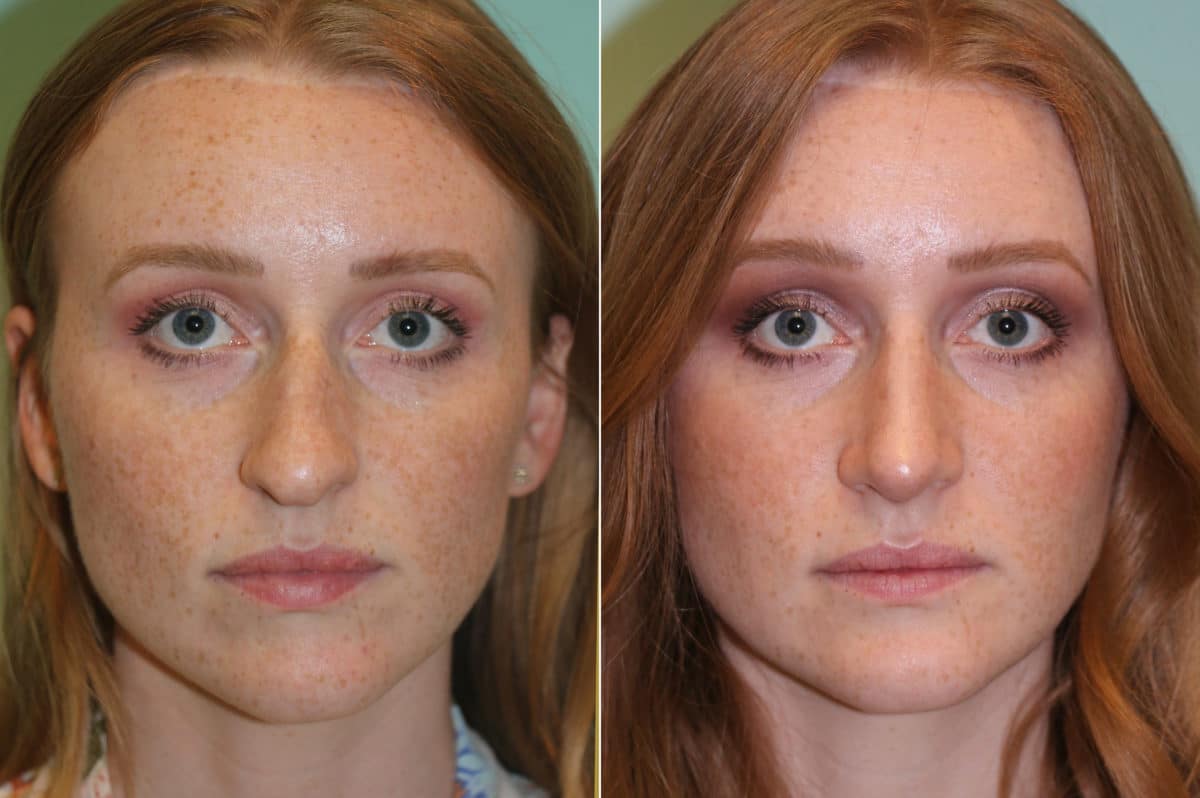 Before and after Rhinoplasty by Dr. Shervin Naderi, Patient 19638